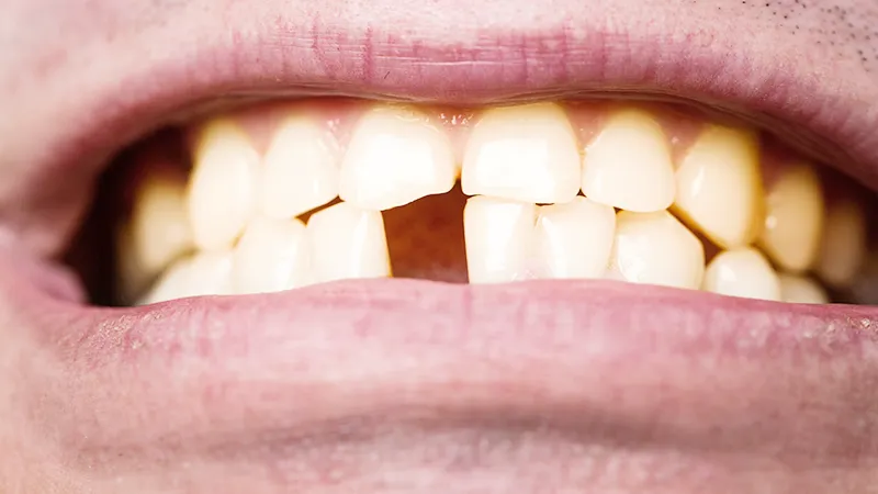 dislodged tooth