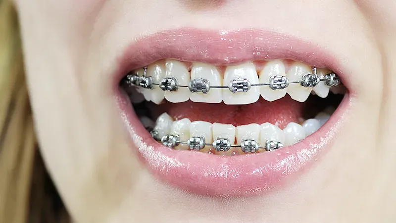 loose braces