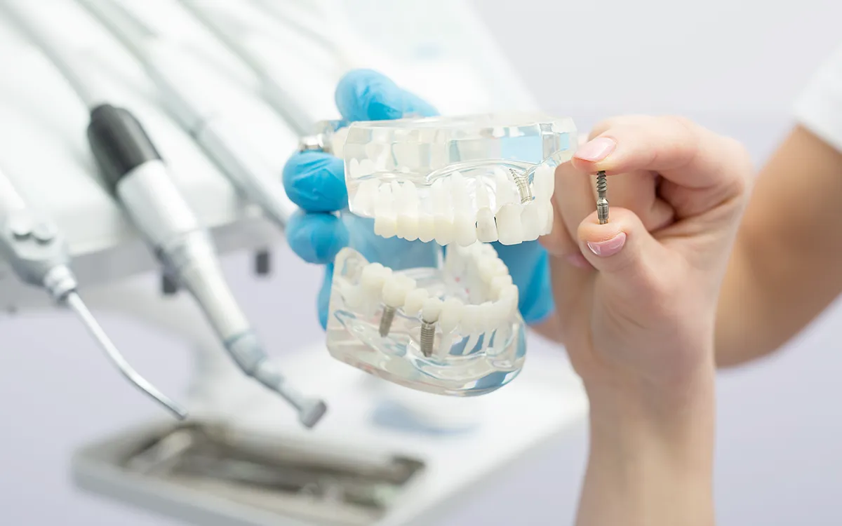Dental implants