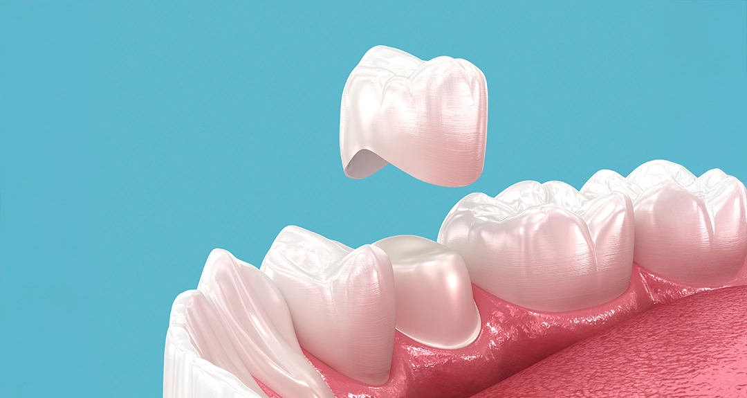 Rock-solid second chances with dental crowns