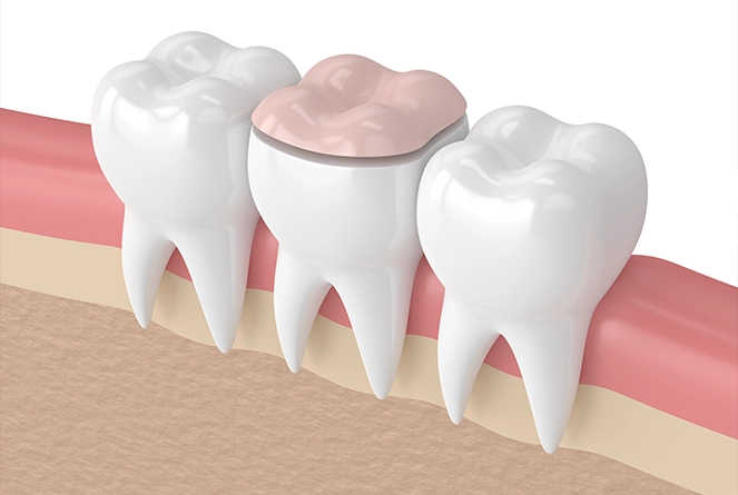 Rock-solid second chances with dental crowns