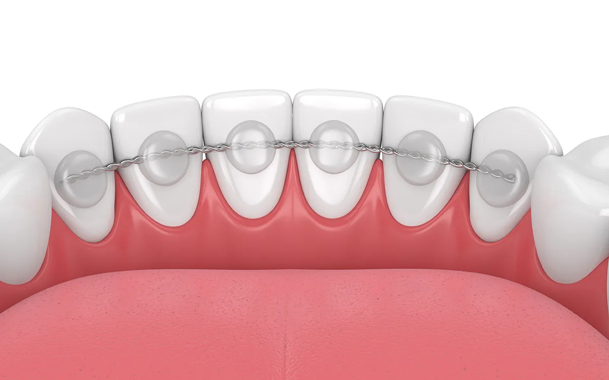 Completion phase and retainers
