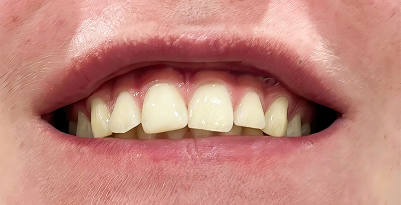 Direct Composite Resin Veneer