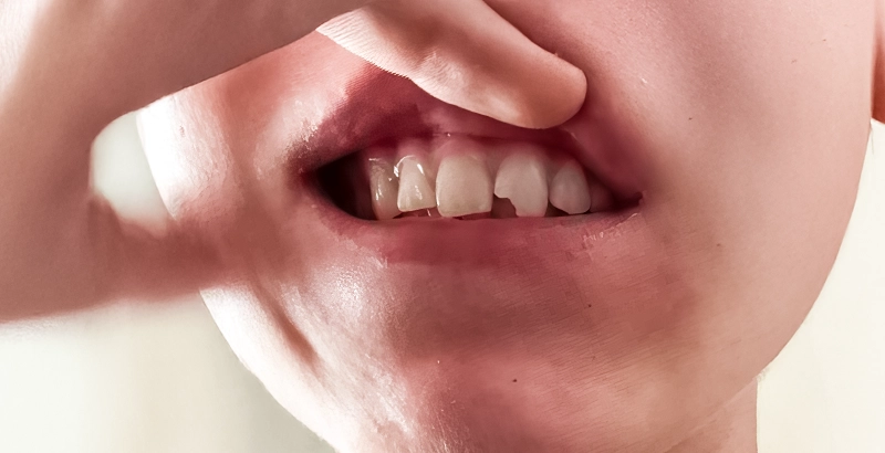 Direct Composite Resin Veneer