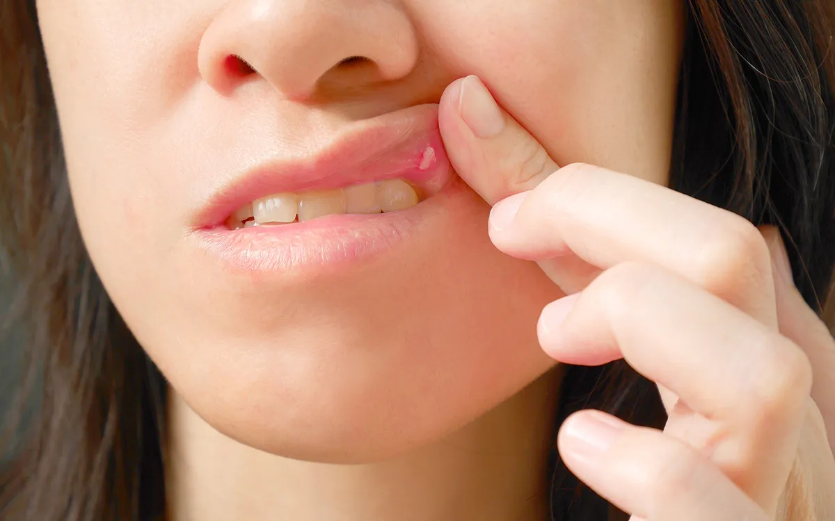 Swelling of the lips