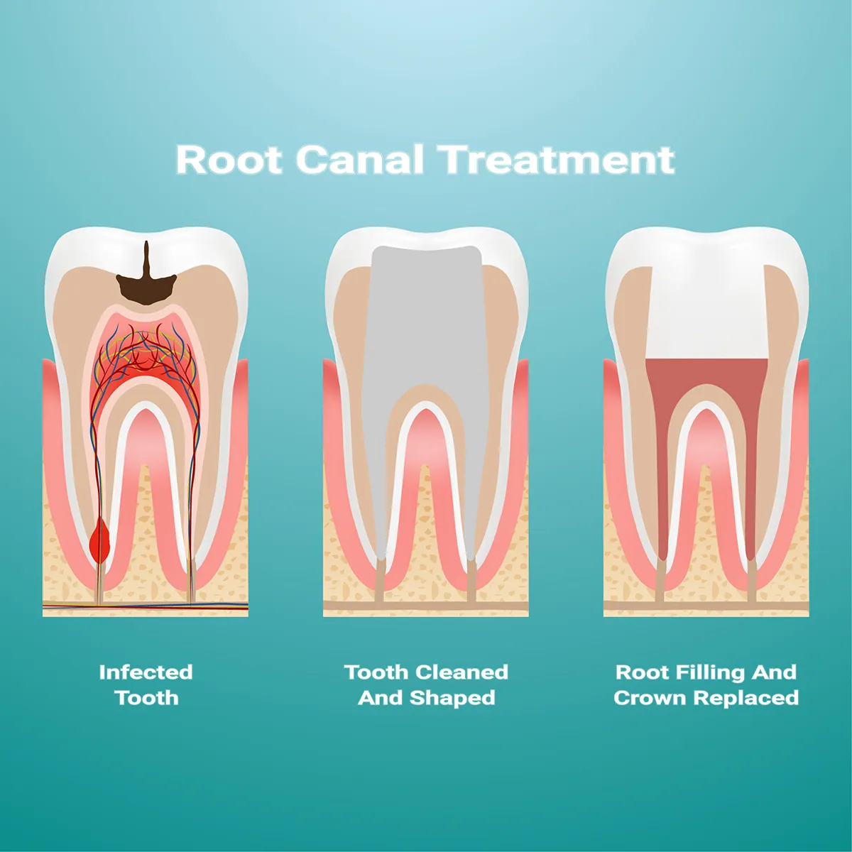 Root Canal Treatment
