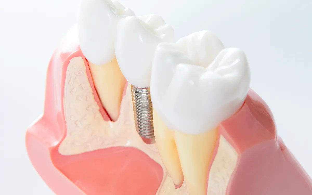 Dental implants
