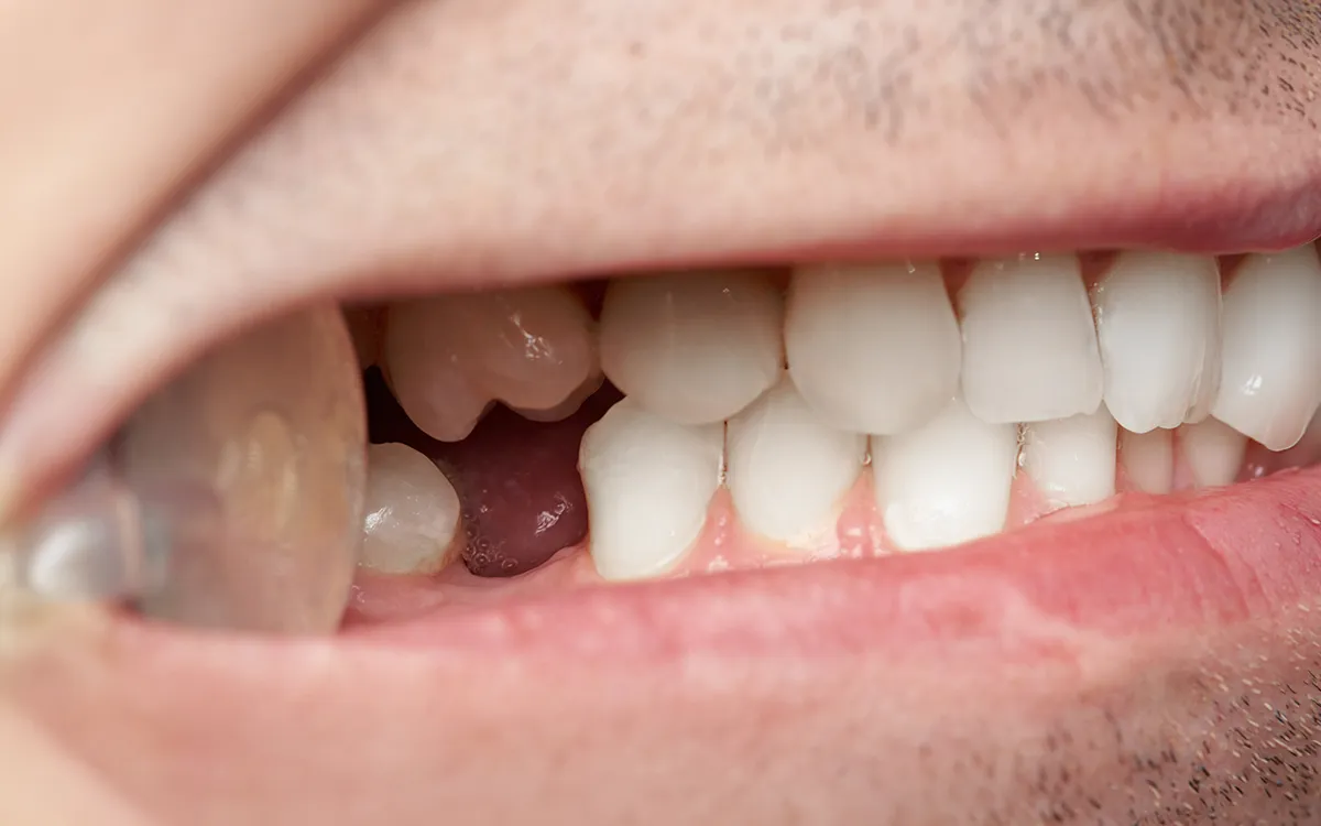 missing tooth