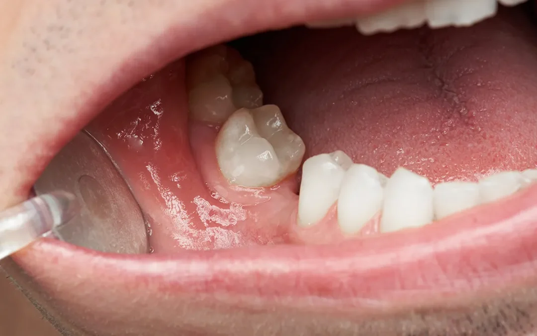 missing tooth
