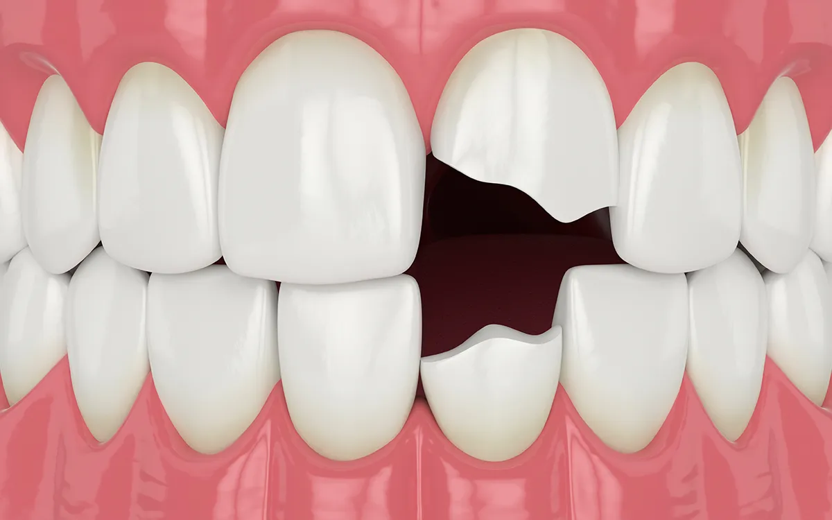 broken tooth